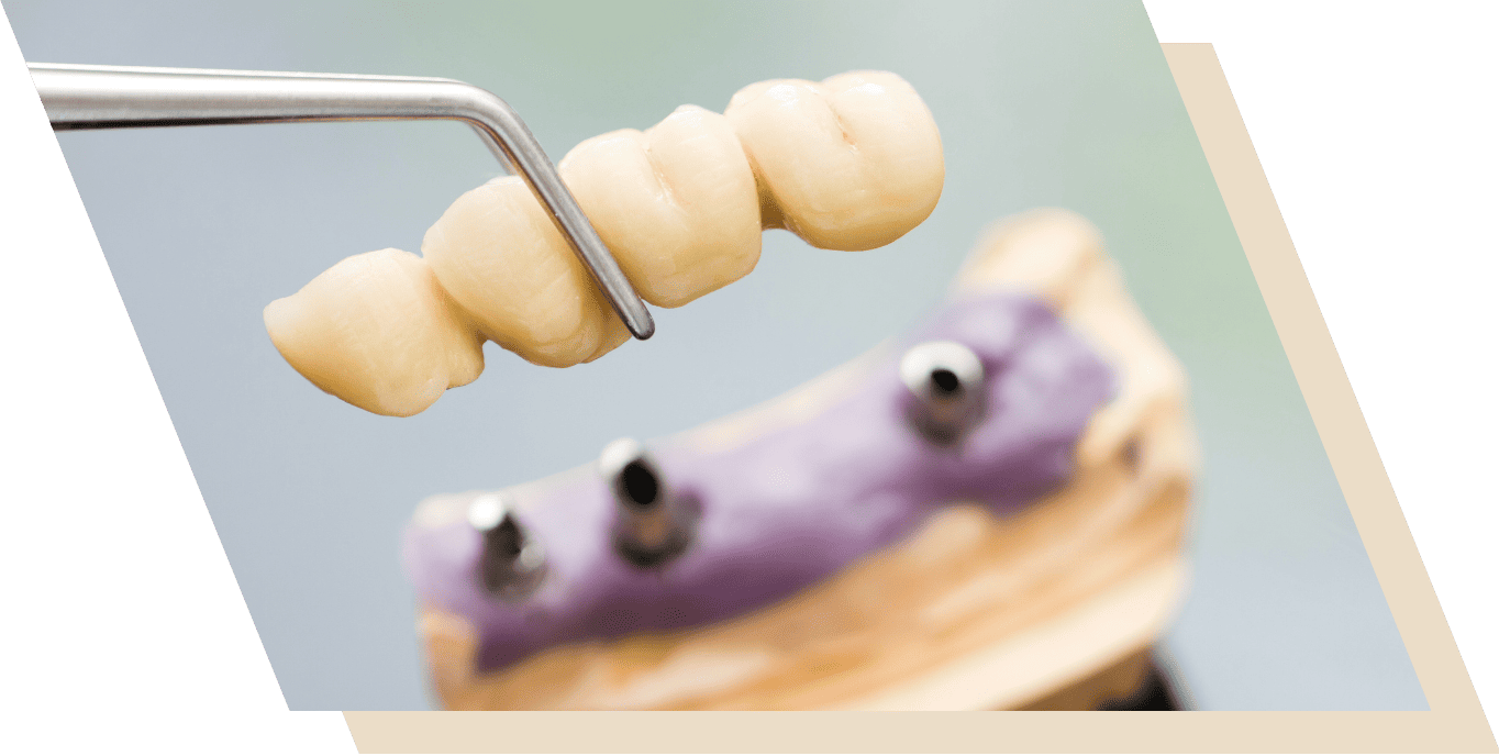 Dental Crowns and Bridges