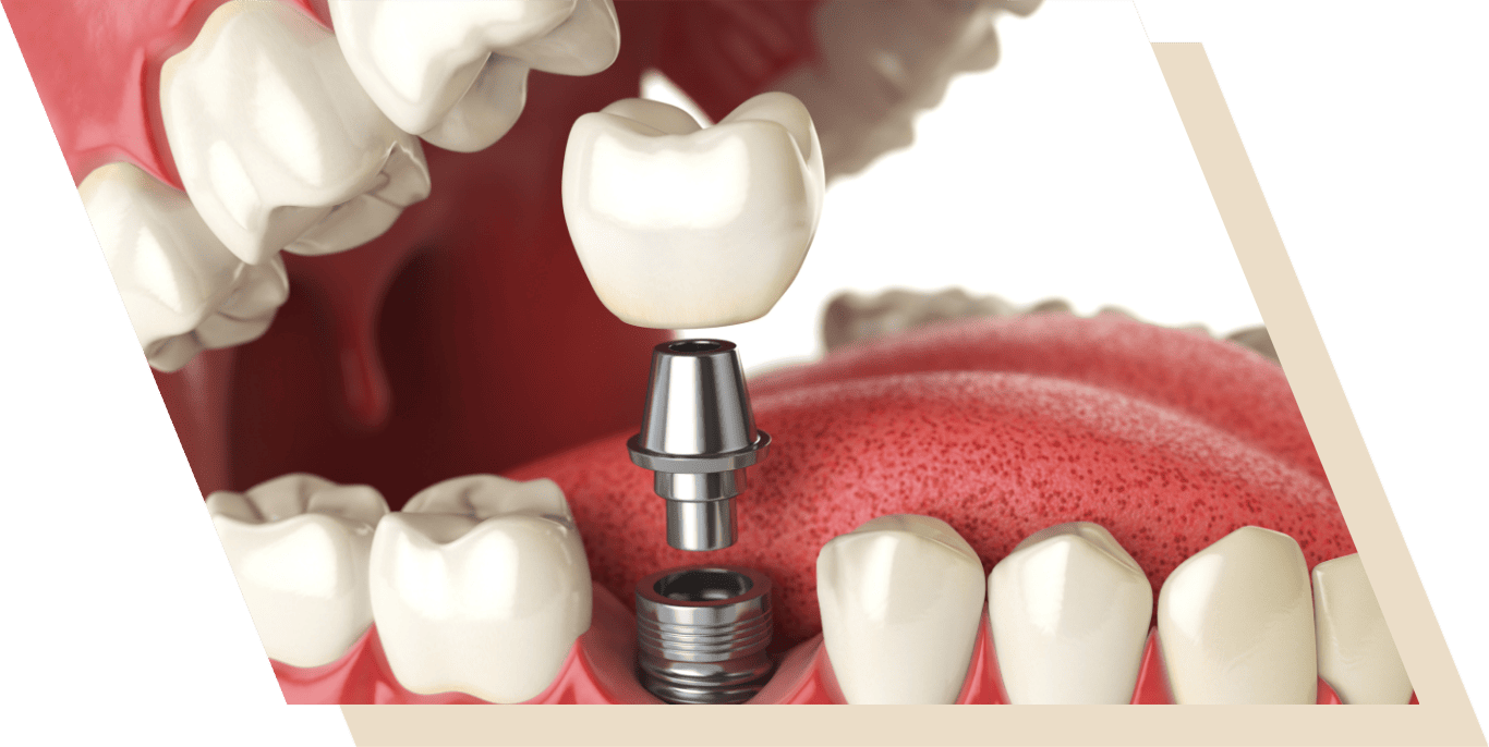 Dental implants