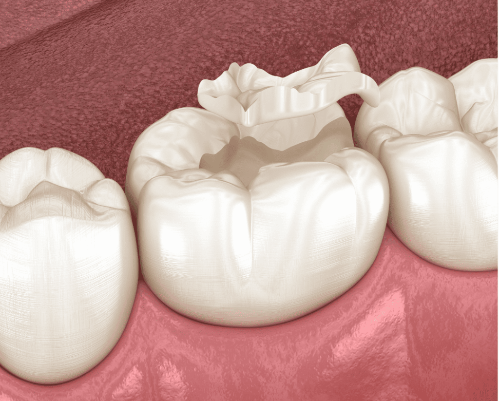 Tooth-Coloured Fillings