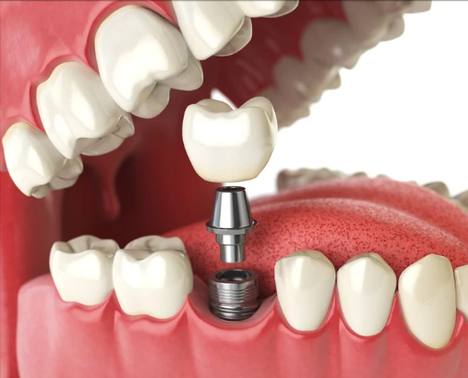 HEARTSLAND-dental-implant