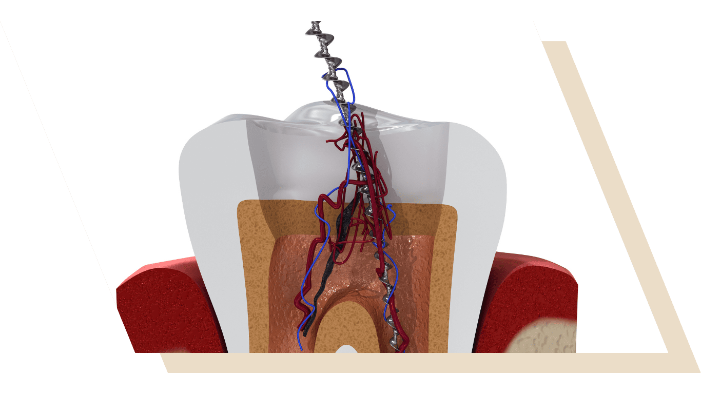Root Canal Treatment