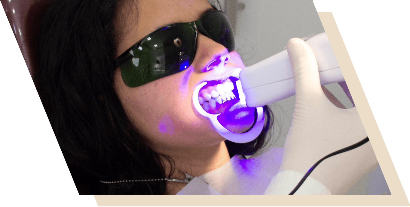 Teeth Whitening