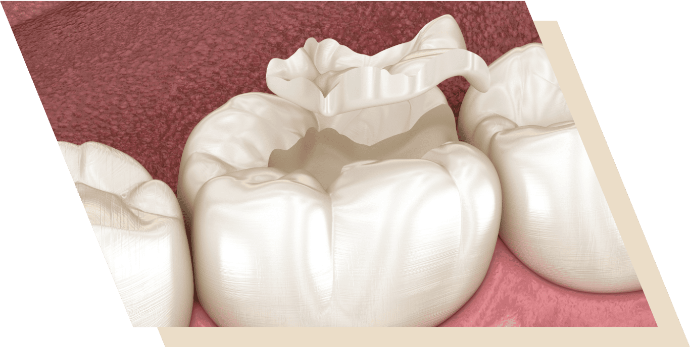 Tooth-Coloured Fillings