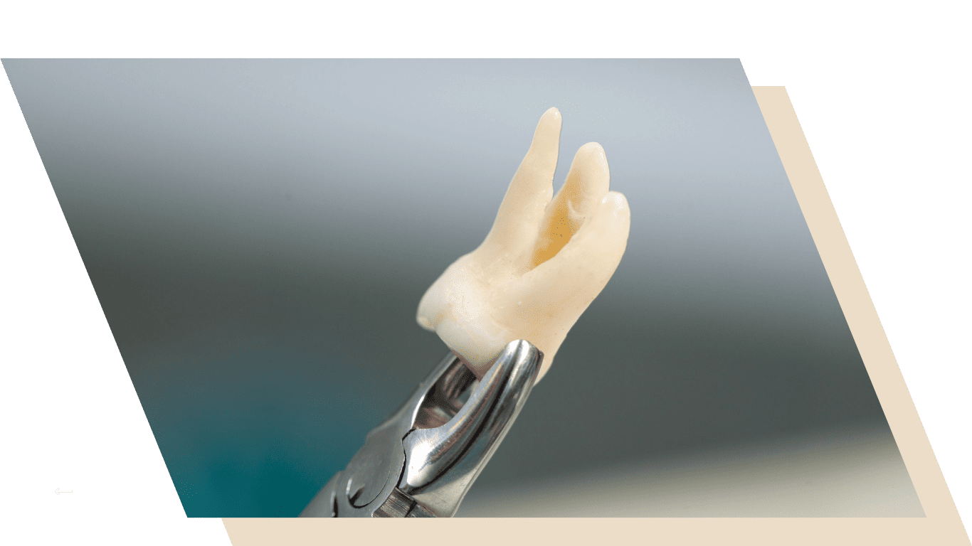 Tooth Extractions