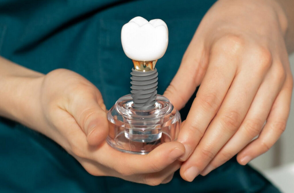 all on 4 dental implants cost near me Hougang